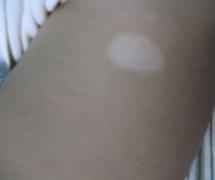 白癜风症状